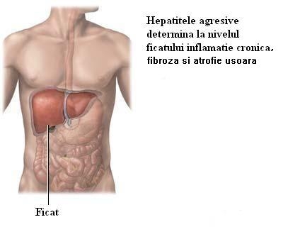 Regim alimentar pentru hepatita cronica